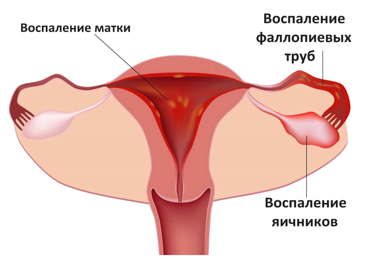 Воспаление полости матки