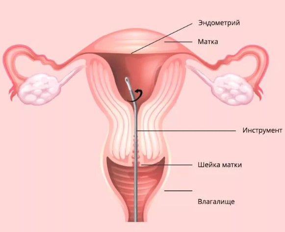 Биопсия эндометрия матки