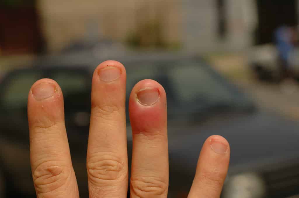 Лечение нарывающего пальца